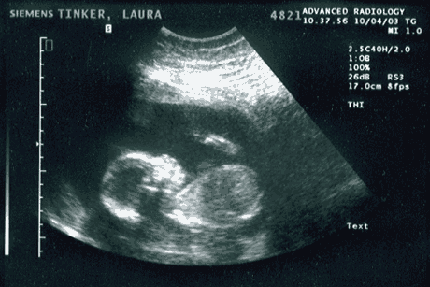 ii_baby_sonogram.gif